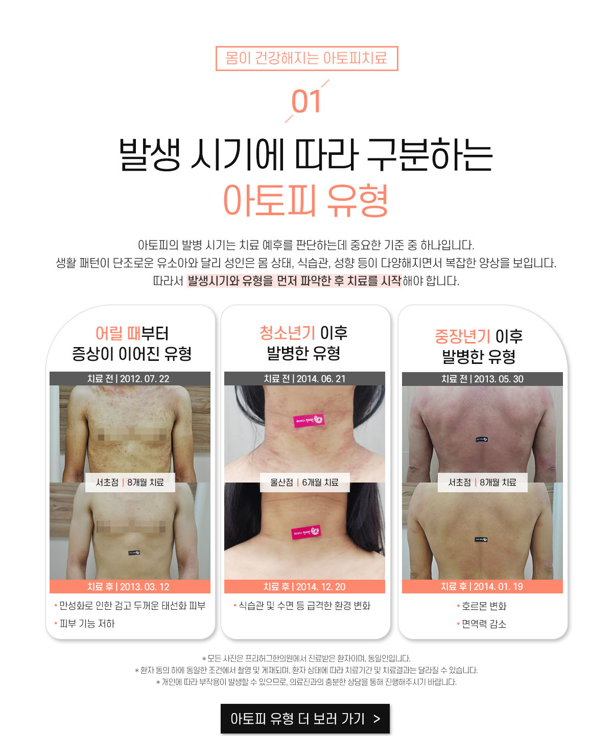 1. 발생 시기에 따라 구분하는 아토피 유형