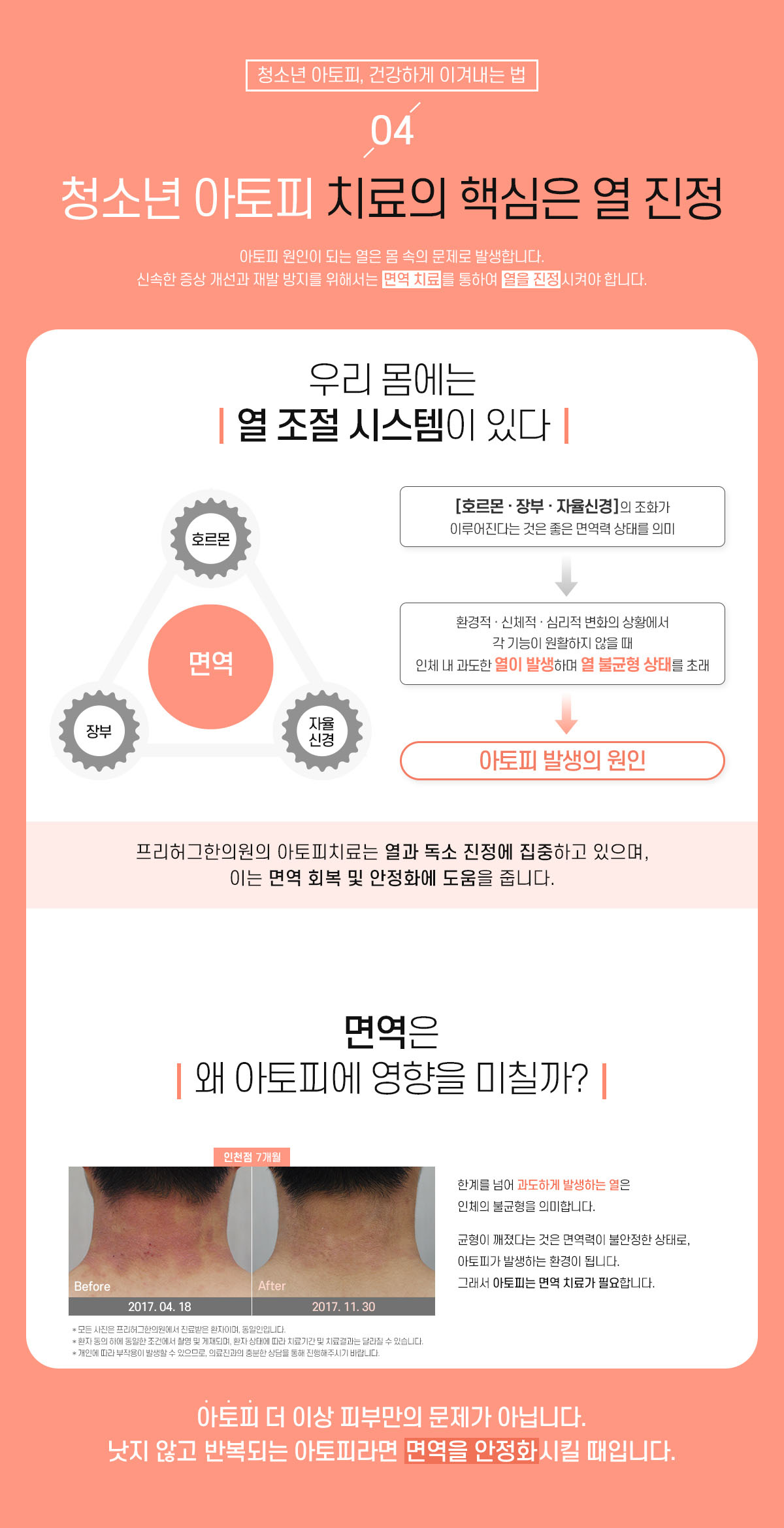 4. 청소년 아토피 치료의 핵심은 열 진정